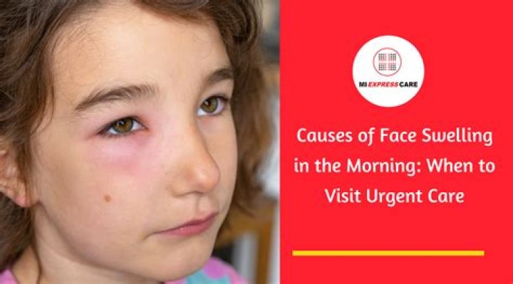 What Happened To Bryan Llenas Face? Forehead Swelling And Bump Explained